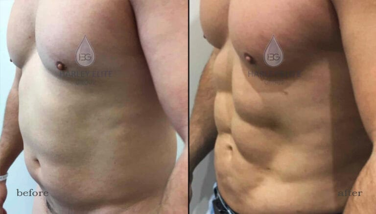 Liposuction-heg-22.jpg