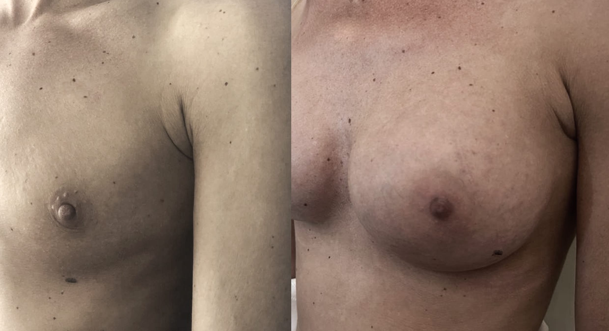 Breast Enhancement2