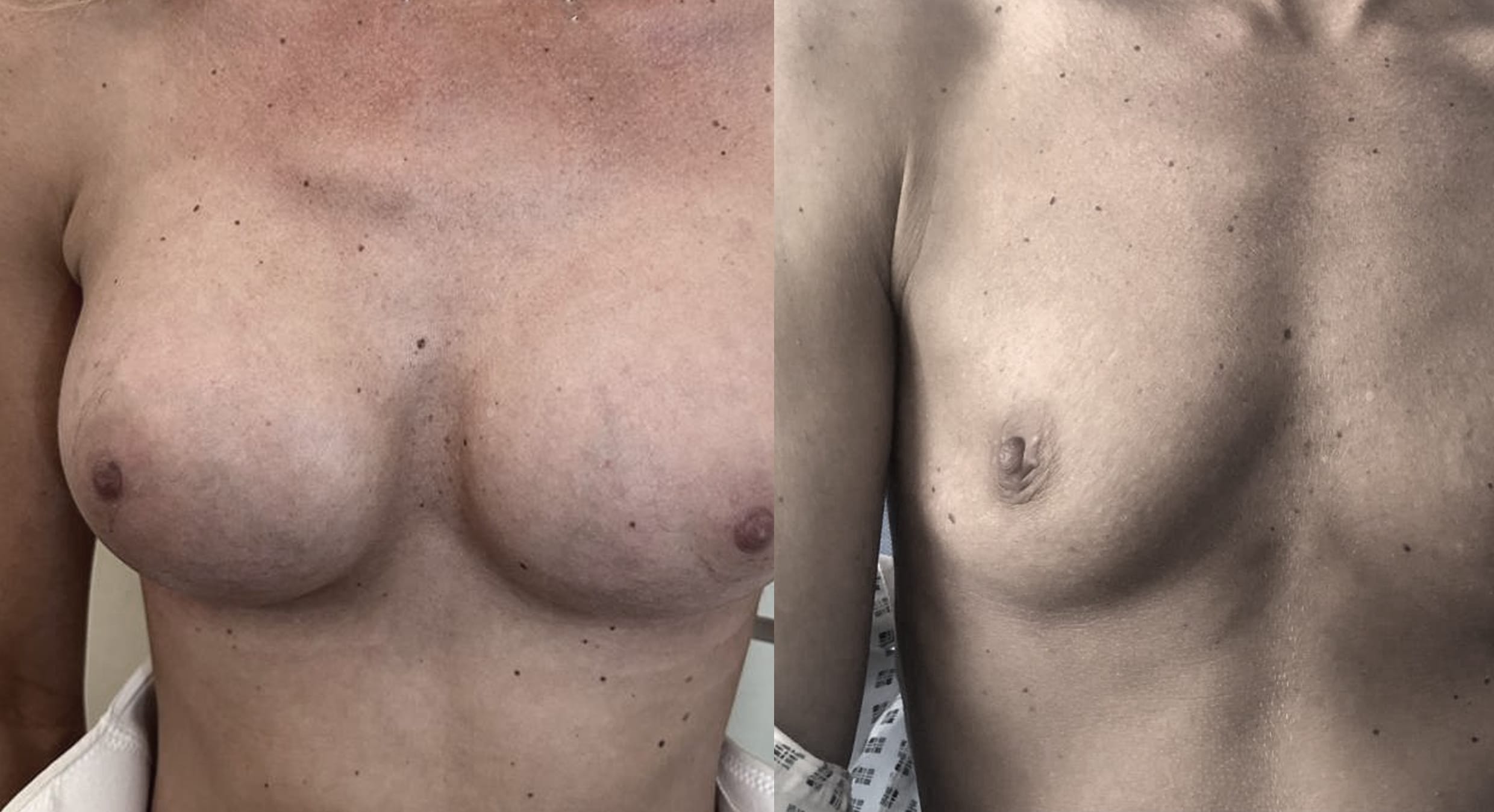 Breast Enhancement3