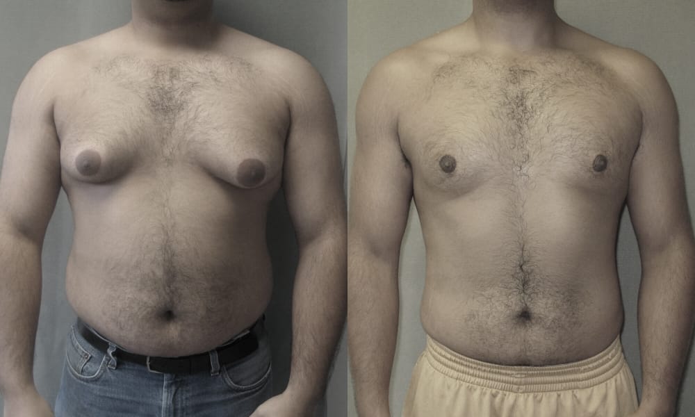 man breast