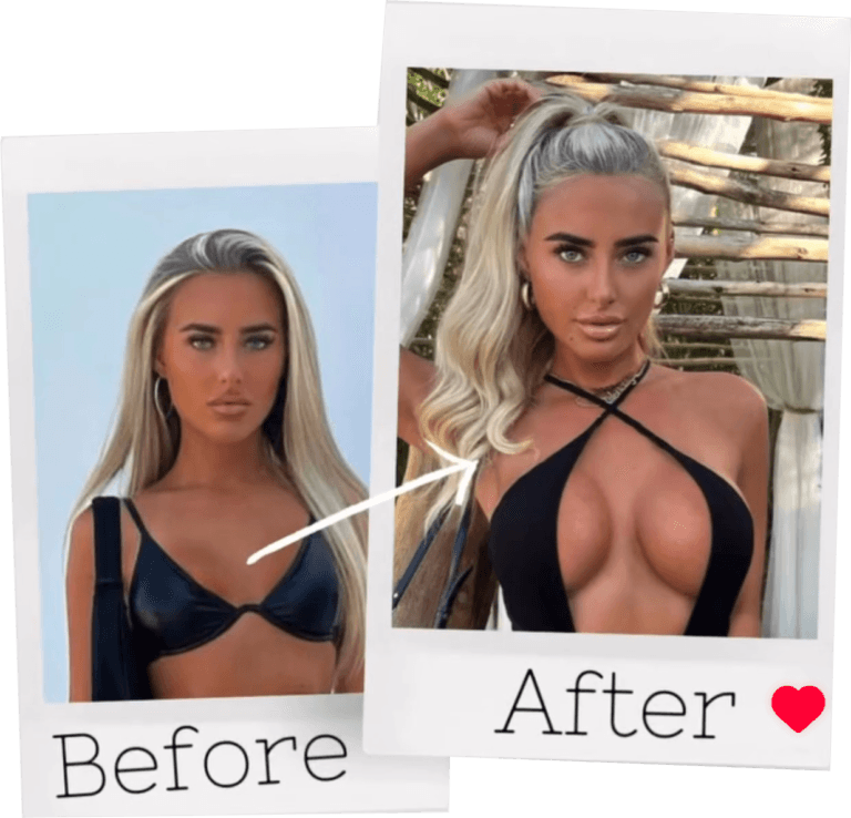Read more about the article BREAST AUGMENTATION – COSMETIC SURGERY